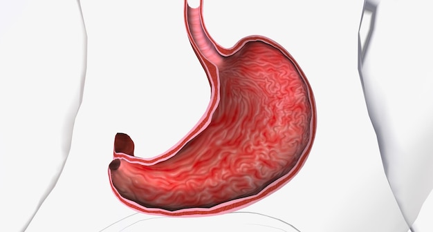 Photo gastritis is a condition in which the stomach lining known as the mucosa is inflamed