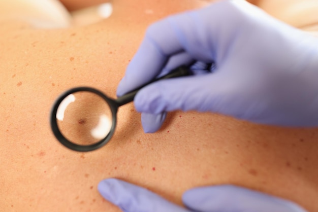 Gloved doctor dermatologist with magnifying glass examines skin of patient