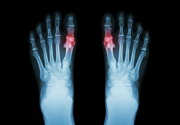 Gout , Rheumatoid arthritis . Film x-ray both foot and arthritis