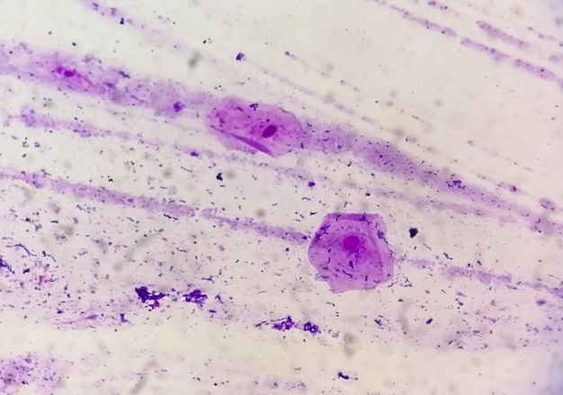 Gram stain of High vaginal swab, photomicrograph.