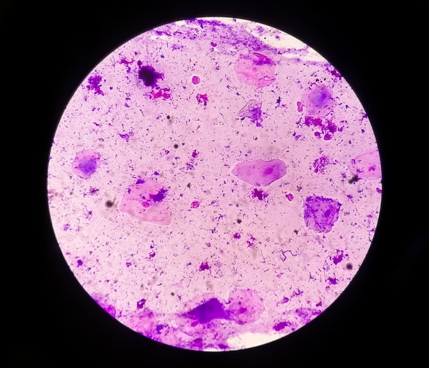 Gram stain of High vaginal swab, photomicrograph.