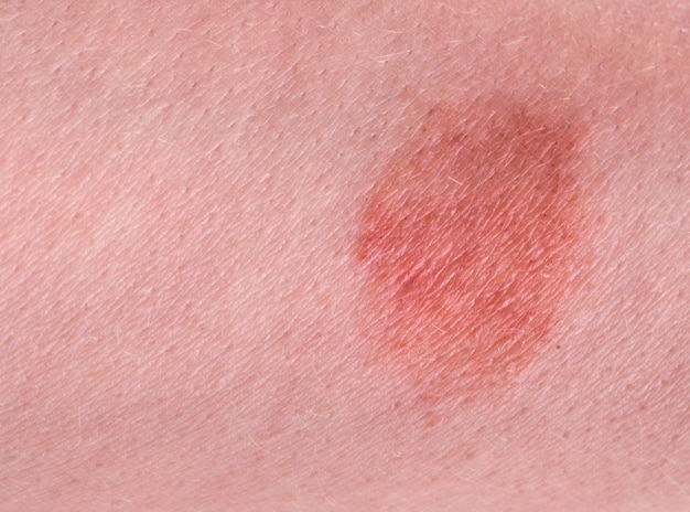 The great red spot on the skin closeup.