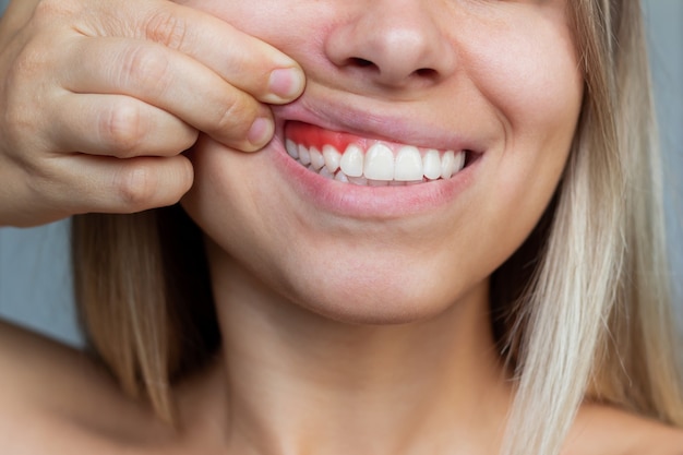 Gum inflammation Closeup of a young woman showing bleeding gums on a gray background Dentistry