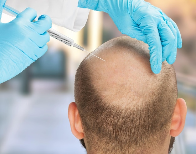 Hair losing man having an injection, hair treatment