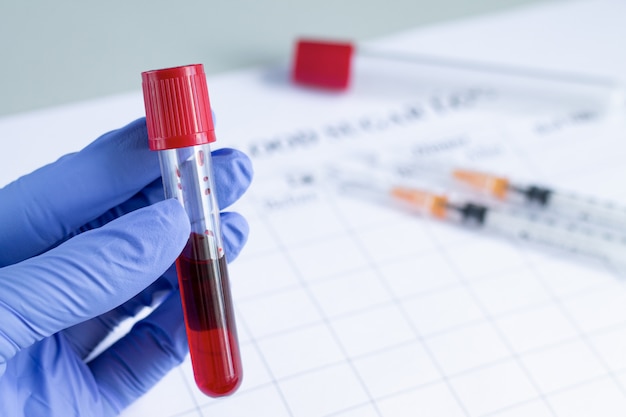 Hand of doctor holding test tube with red blood plasma ready for testing