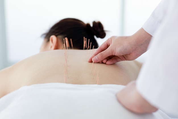 Hand of doctor performing acupuncture therapy . Asian female undergoing acupuncture treatment with a line of fine needles inserted into the her body skin in clinic hospital