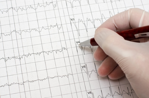 Hand in medical glove holding a ballpoint pen. Electrocardiogram