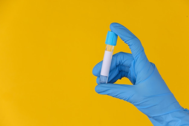 Hand in medical gloves holds a test tube on yellow background