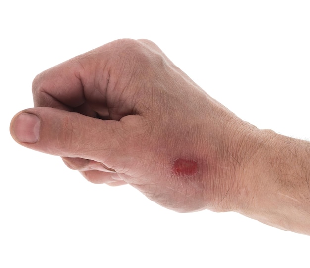 hand with a burn on a white background