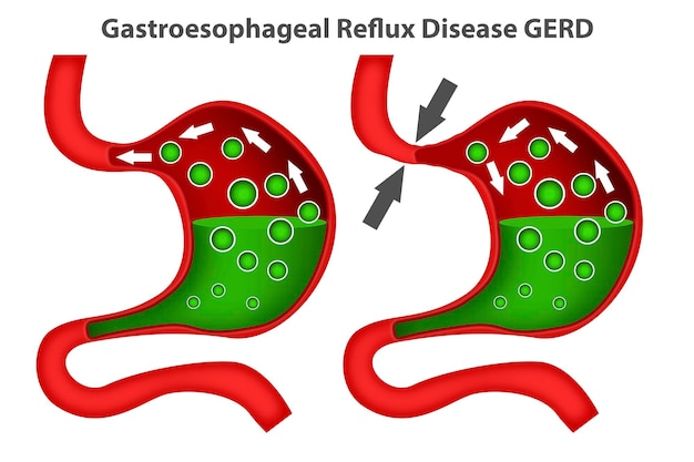 Photo heartburn or gastroesophageal reflux disease