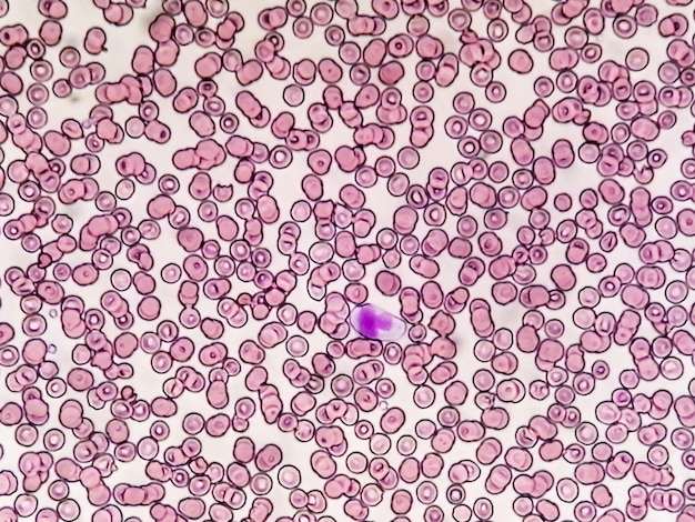 Hematological slide under microscopy showing thrombocytopenia. Extremely low level of platelet count