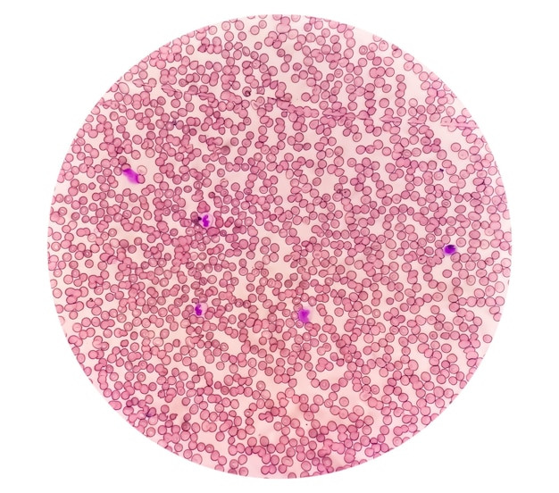 Hematological slide under microscopy showing thrombocytopenia. Extremely low level of platelet count