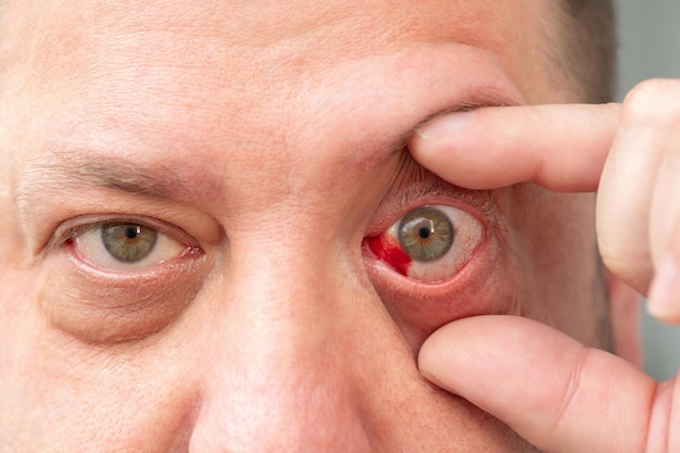 Photo hemorrhage as a result of a ruptured capillary in the mans eye