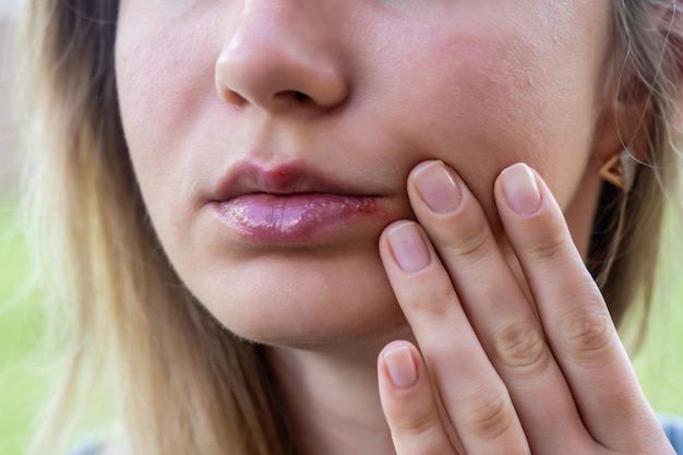 Photo herpes on the lips of young woman close up