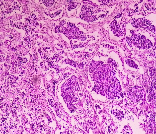 High grade transitional cell carcinoma or TCC a Bladder Cancer or Urothelial carcinoma