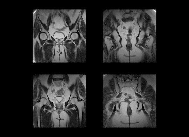 hip and pelvic MRI xray images and ct scan