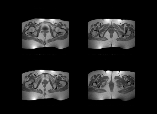 hip and pelvic MRI xray images and ct scan