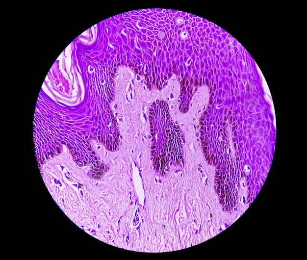 Histological biopsy of Scrotal wall under microscopy showing Calcinosis cutis. Scrotal calcinosis.