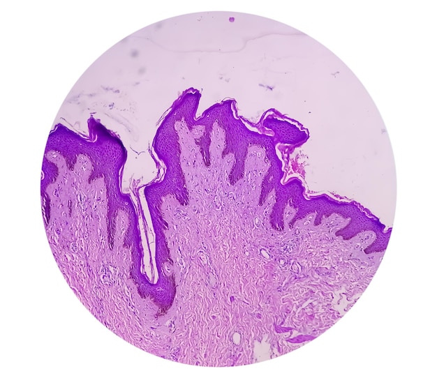 Histological biopsy of Scrotal wall under microscopy showing Calcinosis cutis. Scrotal calcinosis.