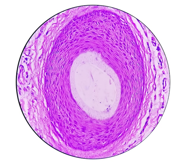 Histological biopsy of Scrotal wall under microscopy showing Calcinosis cutis. Scrotal calcinosis.