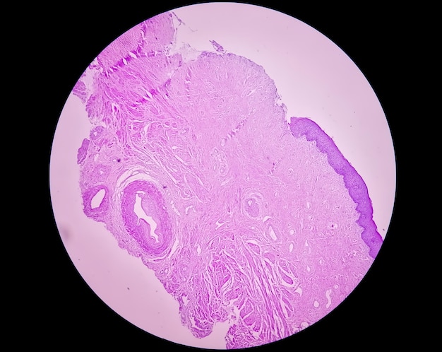 Histological examination of uterus biopsy suggestive uterine prolapse. Chronic cervical prolapse.