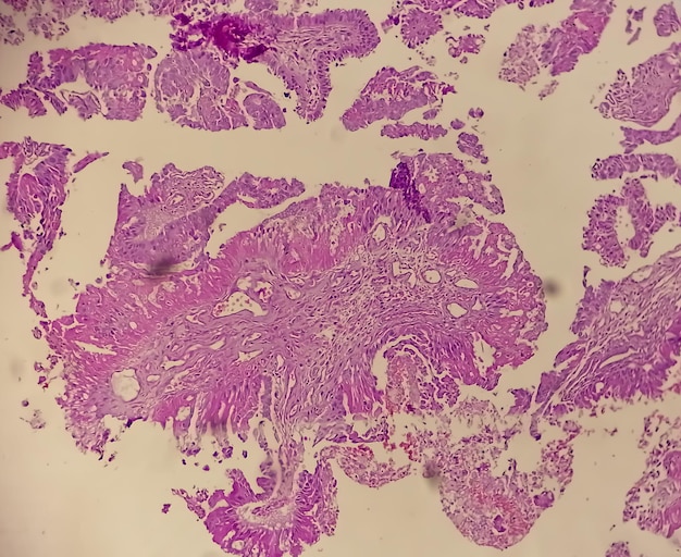 Histology of metastatic papillary adenocarcinoma