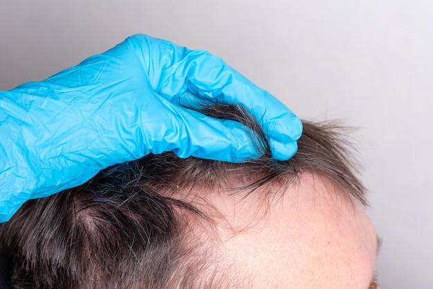 Human baldness or hair loss after coronavirus - a doctor in blue medical gloves examines the hair and scalp of a man, close-up. Human alopecia concept. Hair loss problem