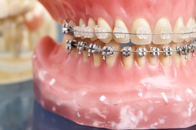 Human jaw model with teeth and wired dental braces