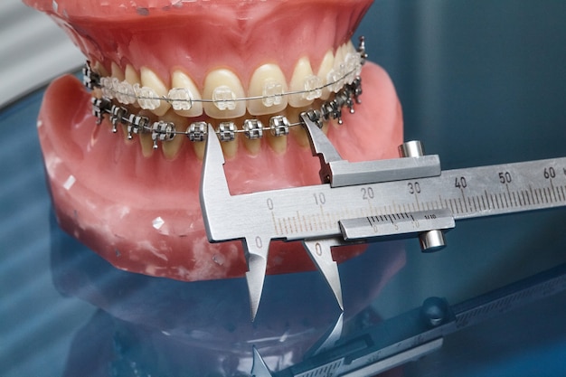 Human jaw or teeth model with metal wired dental braces and vernier caliper