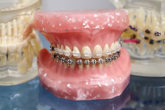 Human jaw or teeth model with metal wired dental braces