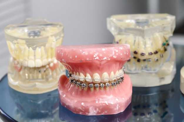 Human jaw or teeth model with metal wired dental braces