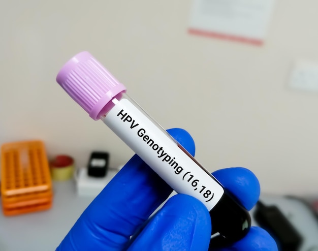 Human Papilloma virus or HPV Genotyping PCR testing