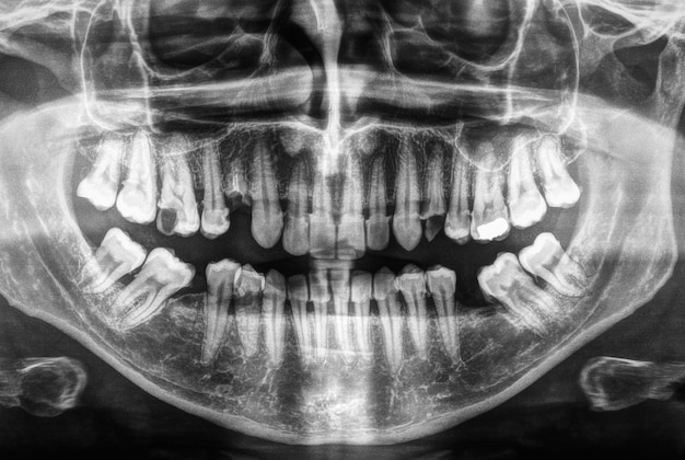 Photo human teeth xray in black and white