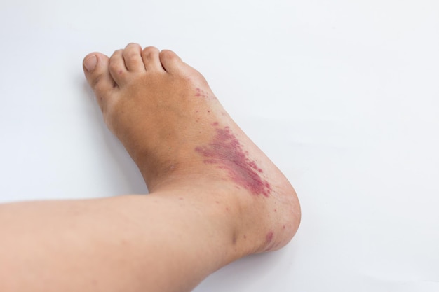 Infectious disease of the legs Foot fungus and allergic rash