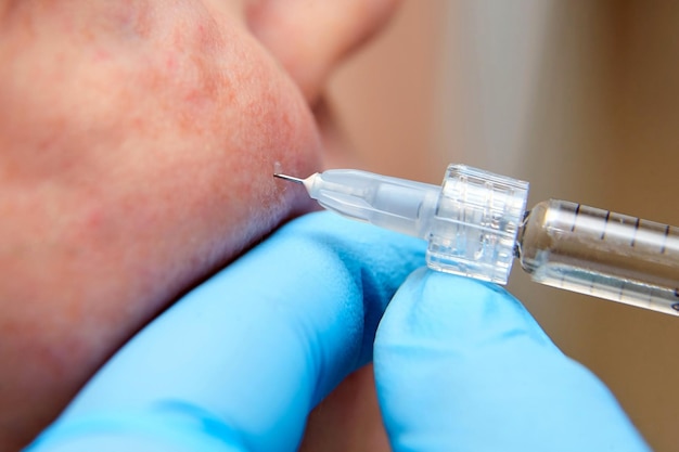 Injection cosmetology Biorevitalization Procedure Closeup of hands in gloves holding syringe