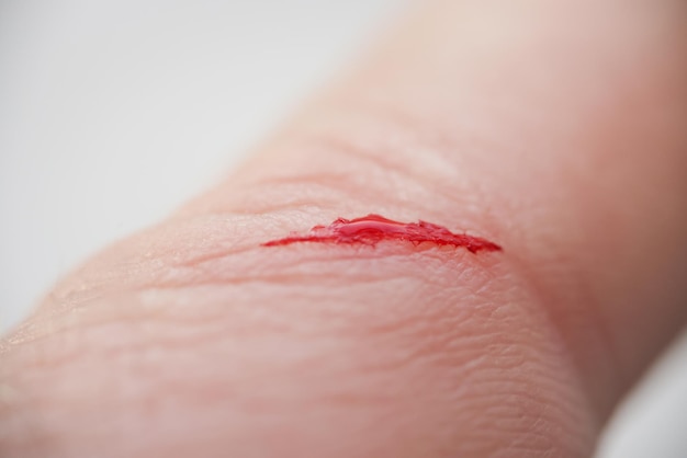 Injured persons finger with bleeding open cut wound