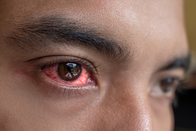 Irritated red eyes needs sterile eye drops