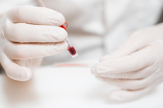 Laboratory assistant holds test tube closeup for gynecological and cytological analysis Woman scientist working in medical lab