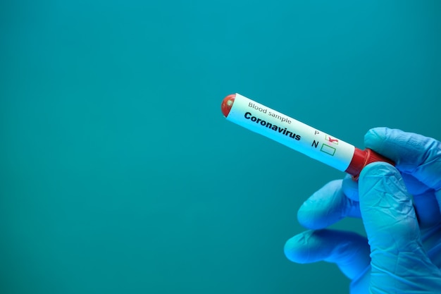 laboratory technician hand holding corona blood test tube