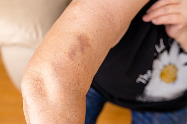 Large bruises on the arm of human from accident