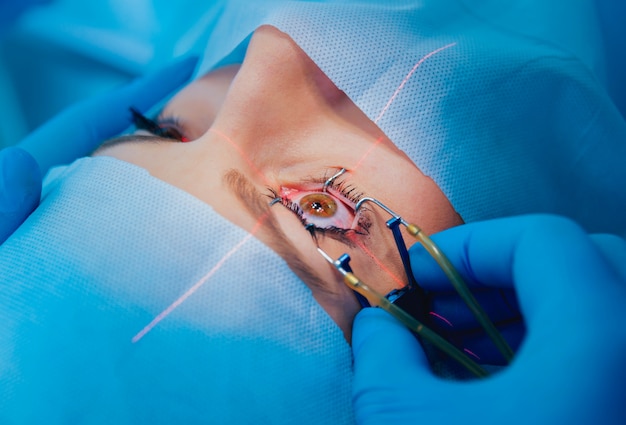 Laser vision correction. A patient and team of surgeons in the operating room during ophthalmic surgery. Eyelid speculum. Lasik treatment.