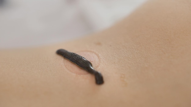 Leech on skin of blonde young woman - hirudotherapy - close up view