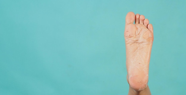 Left Foots peeling or remove dead skin on mint green background