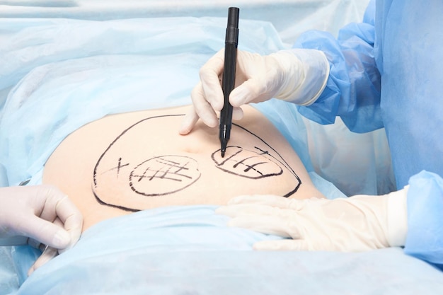 Photo liposuction operation doctor hands near belly