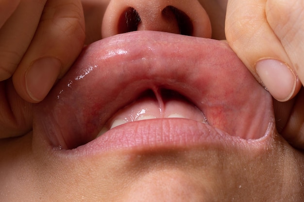 Lips disorders and diseases concept of fordyce spot and how to prevent it