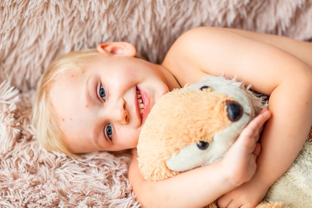 Little baby boy with Varicella virus or Chickenpox bubble rash at home