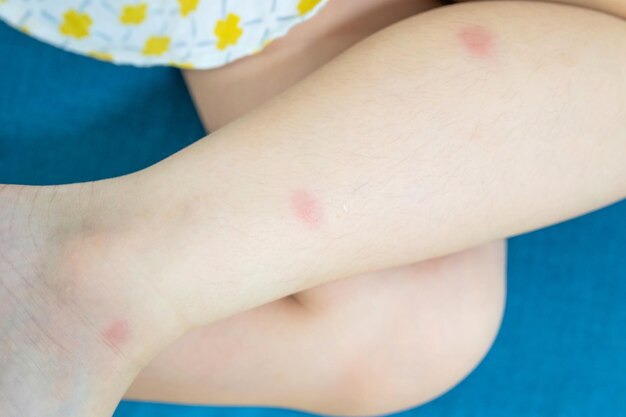 Photo little girl has skin rash allergy itching on her leg