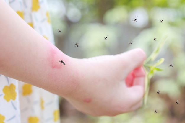 Photo little girl has skin rash allergy itching and scratching on her arm with mosquitoes bite