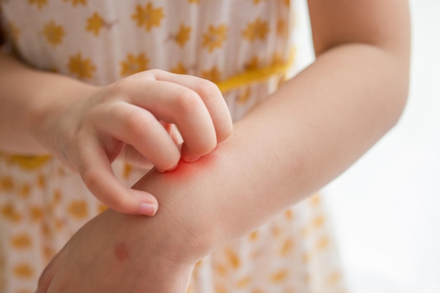 Photo little girl has skin rash allergy itching and scratching on her arm