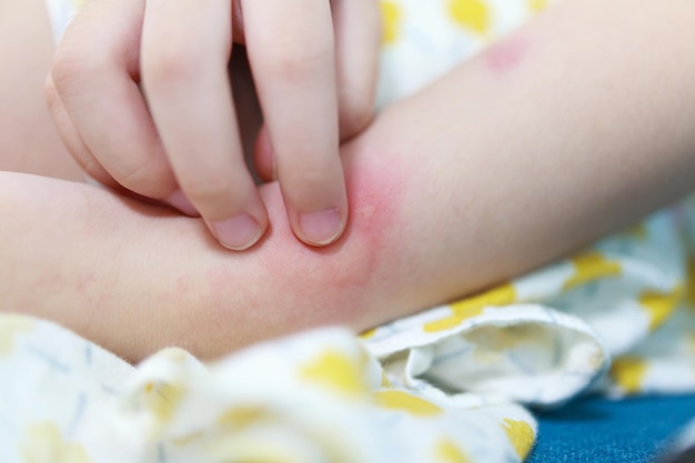 Photo little girl has skin rash allergy itching and scratching on her arm